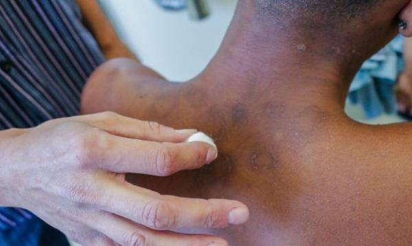 Durante o ‘Janeiro Roxo’, Saúde de Cotia reforça conscientização sobre a hanseníase